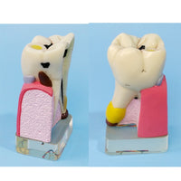 Modelo anatomíco- patología dientes humanos
