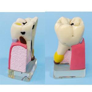 Modelo anatomíco- patología dientes humanos