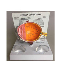 Modelo Optico Cataratas anatomia (cornea)
