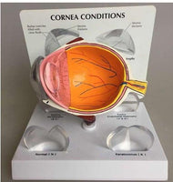 Modelo Optico Cataratas anatomia (cornea)
