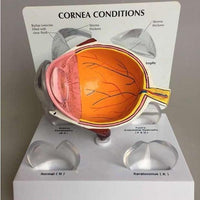 Modelo Optico Cataratas anatomia (cornea)