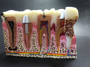 Modelo anatomico patologías dentales comunes