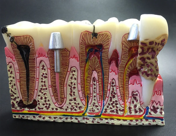 Modelo anatomico patologías dentales comunes