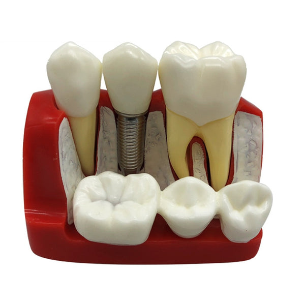 Iimplante Dental restauración corona puente 