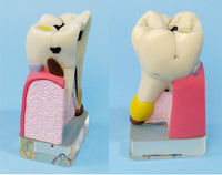 Modelo anatomíco- patología dientes humanos
