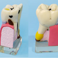 Modelo anatomíco- patología dientes humanos