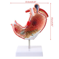 Modelo Anatomico Estomago (Patologias)
