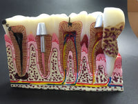 Modelo anatomico patologías dentales comunes
