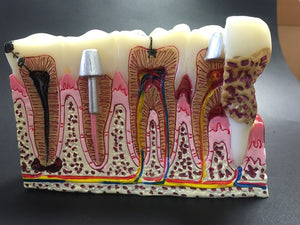 Modelo anatomico patologías dentales comunes