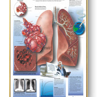 Póster de patologías humanas 