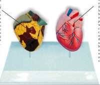 Modelo anatomico comparativo corazon de fumador
