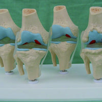 Anatomia degeneracion de rodilla