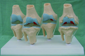 Anatomia degeneracion de rodilla