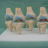 Anatomia degeneracion de rodilla