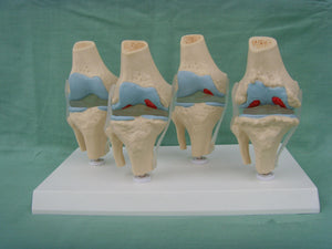 Anatomia degeneracion de rodilla