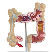 Modelo Anatomico intestino grueso (Patologias)
