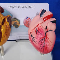 Modelo anatomico comparativo corazon de fumador