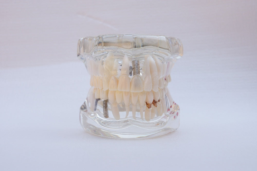 Modelo de implantes dentales