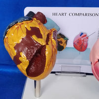 Modelo anatomico comparativo corazon de fumador