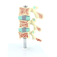 Anatomia osteoporosis intra-vertebral.