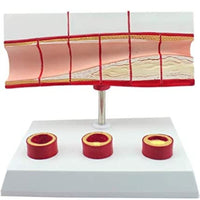 Modelo anatomico de colesterol en sangre arterias ateroesclerosis