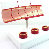 Modelo anatomico de colesterol en sangre arterias ateroesclerosis