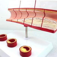 Modelo anatomico de colesterol en sangre arterias ateroesclerosis