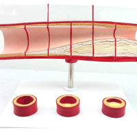 Modelo anatomico de colesterol en sangre arterias ateroesclerosis