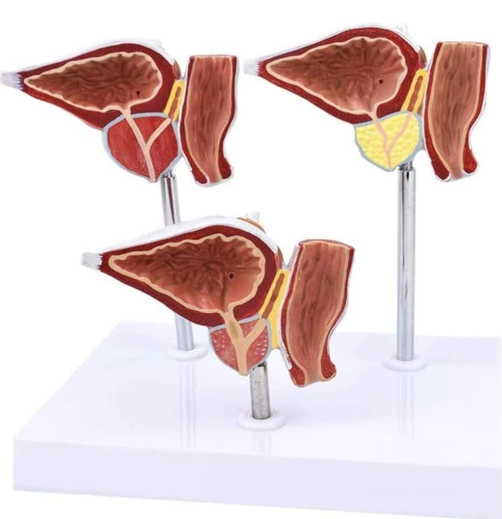 Modelo prostata comparativo saludable lesionada enferma