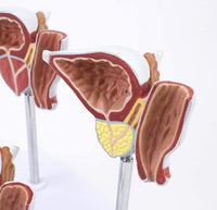 Modelo prostata comparativo saludable lesionada enferma
