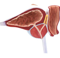 Modelo prostata comparativo saludable lesionada enferma
