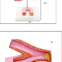 Modelo de arteriosclerosis con trombo vaso sanguineo