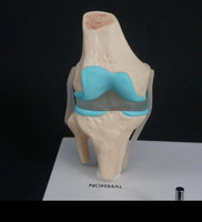 Anatomia degeneracion de rodilla - modelos anatomicos
