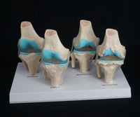 Anatomia degeneracion de rodilla - modelos anatomicos
