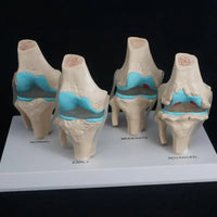 Anatomia degeneracion de rodilla - modelos anatomicos