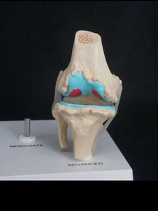 Anatomia degeneracion de rodilla - modelos anatomicos