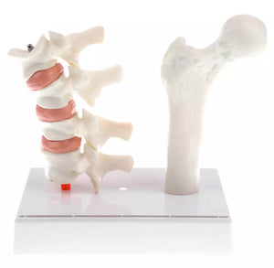 Modelo de Osteoporosis y morbilidad en el hueso femoral y vertebras