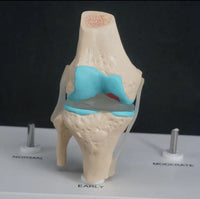 Anatomia degeneracion de rodilla - modelos anatomicos
