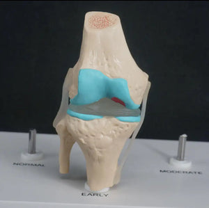 Anatomia degeneracion de rodilla - modelos anatomicos