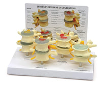 Modelo anatómico degeneracion lumbar vertebras
