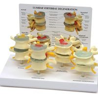 Modelo anatómico degeneracion lumbar vertebras