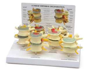 Modelo anatómico degeneracion lumbar vertebras