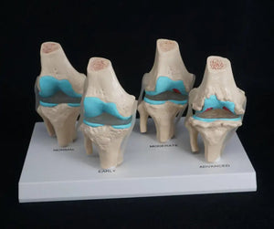 Anatomia degeneracion de rodilla - modelos anatomicos