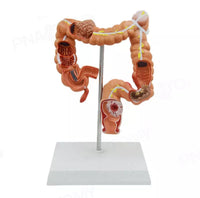 Modelo  de Colon y Recto - patologia cancer
