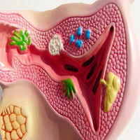 Modelo anatómico uterino - Enfermedad Vaginal  Enf transmision sexual