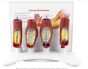 Modelo anatómico de corazón - enfermedad coronaria